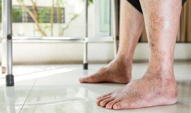 Diabetes : Tantangan Kesehatan Global dan Cara Mengelolanya dengan Baik