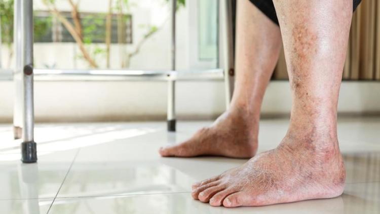 Diabetes : Tantangan Kesehatan Global dan Cara Mengelolanya dengan Baik